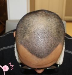 -大麦微针植发丨全国连锁