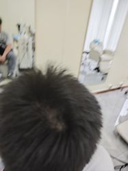 -碧莲盛·不剃发植发