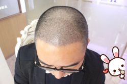 -大麦微针植发丨全国连锁