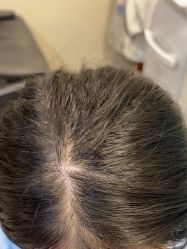 -碧莲盛·不剃发植发