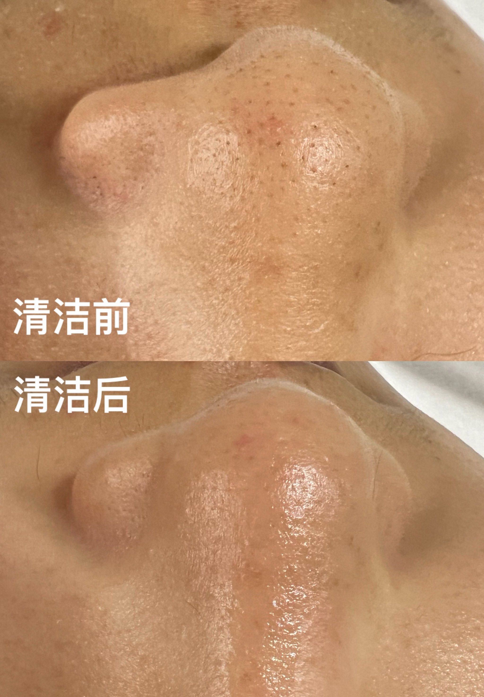 nice day-
好皮肤离不开深层清洁
正确清理毛孔堵塞的垃圾
