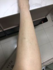体验后-嘉和医学脱毛中心