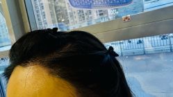 -碧莲盛·不剃发植发