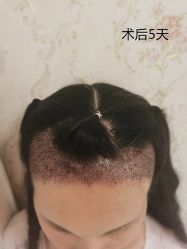 -北京雍禾植发医院