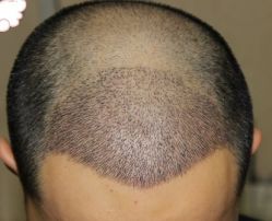 -大麦微针植发丨全国连锁