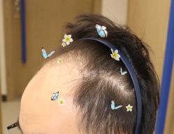 -大麦微针植发全国连锁