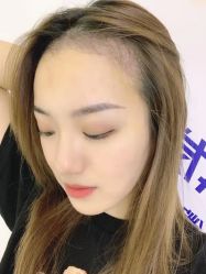 -大麦微针植发丨全国连锁