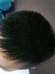 -碧莲盛·不剃发植发