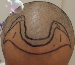 -大麦微针植发全国连锁
