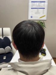 体验前-大麦微针植发全国连锁