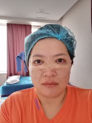 体验后-天津健丽·去眼袋医疗美容机构