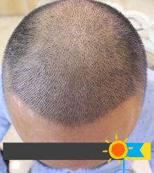 -大麦微针植发丨全国连锁