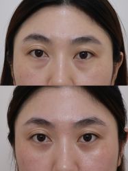 -广州健丽·去眼袋医疗美容机构