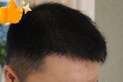 -大麦微针植发丨全国连锁