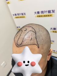 -大麦微针植发全国连锁