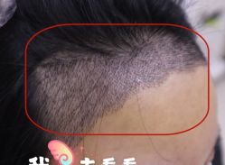 -大麦微针植发全国连锁