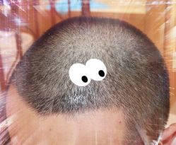 -大麦微针植发全国连锁