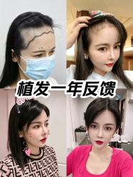 -大麦微针植发全国连锁