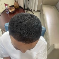 -大麦微针植发丨全国连锁