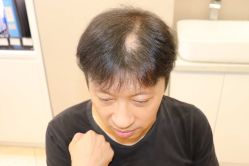 点击看大图 -大麦微针植发丨全国连锁