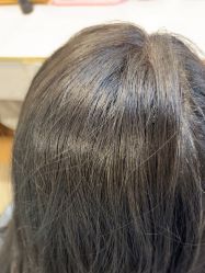 -碧莲盛·不剃发植发