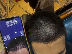 -碧莲盛·不剃发植发