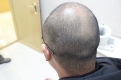 点击看大图 -大麦微针植发丨全国连锁