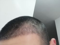 体验后-碧莲盛·不剃发植发