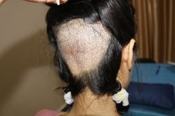 点击看大图 -大麦微针植发丨全国连锁