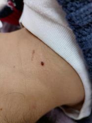 -痣清宫祛斑祛痣连锁店