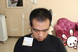 -大麦微针植发丨全国连锁