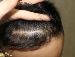 -大麦微针植发丨全国连锁