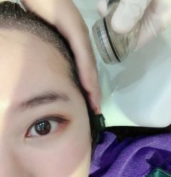 -碧莲盛·不剃发植发