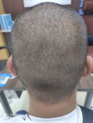 点击看大图 -雍禾植发全国连锁