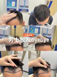 -大麦微针植发全国连锁