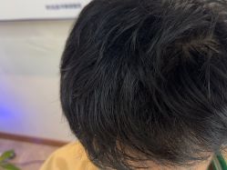 -碧莲盛·不剃发植发