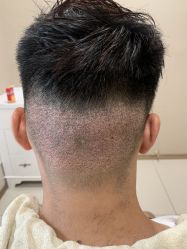 -大麦微针植发丨全国连锁