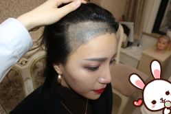 点击看大图 -大麦微针植发丨全国连锁