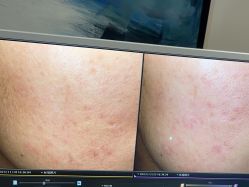 -苑苑vbeauty科技美容SPA
