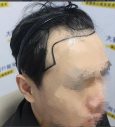 -大麦微针植发丨全国连锁