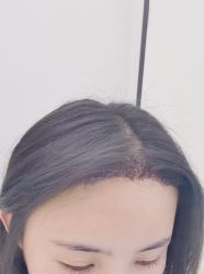 点击看大图 -大麦微针植发丨全国连锁