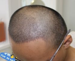 -大麦微针植发丨全国连锁