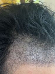 -碧莲盛·不剃发植发