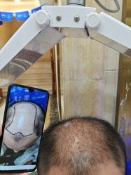 -碧莲盛·不剃发植发