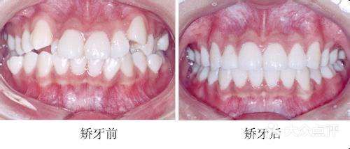 什么是口腔正畸？