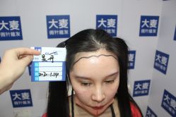 -大麦微针植发丨全国连锁