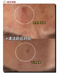 -苗坊净颜痘斑美容护肤连锁