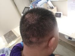 -碧莲盛·不剃发植发