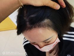 -大麦微针植发丨全国连锁