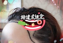 -大麦微针植发全国连锁